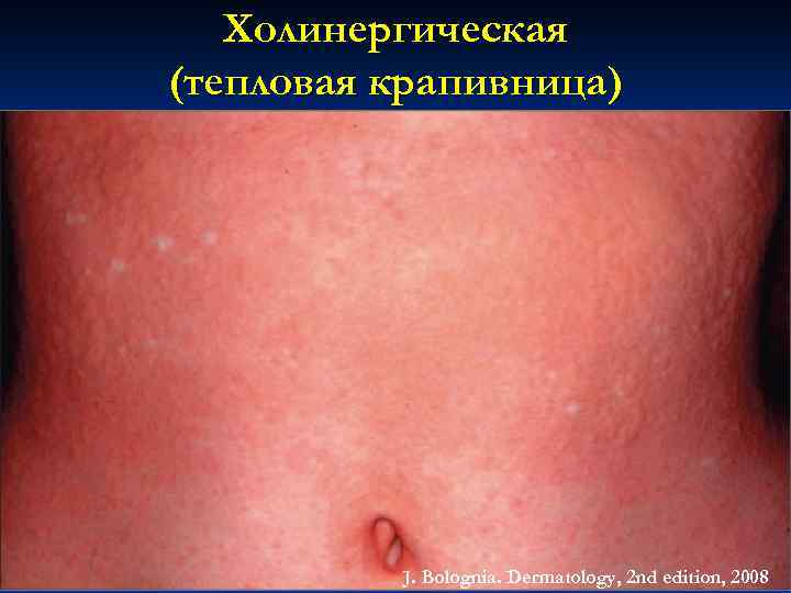 Холинергическая (тепловая крапивница) J. Bolognia. Dermatology, 2 nd edition, 2008 