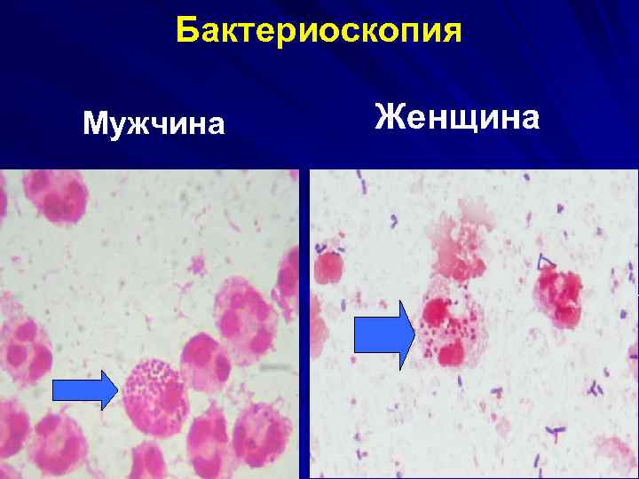 Бактериоскопия Мужчина Женщина 