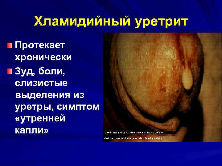 Хламидийный уретрит Протекает хронически Зуд, боли, слизистые выделения из уретры, симптом «утренней капли» 