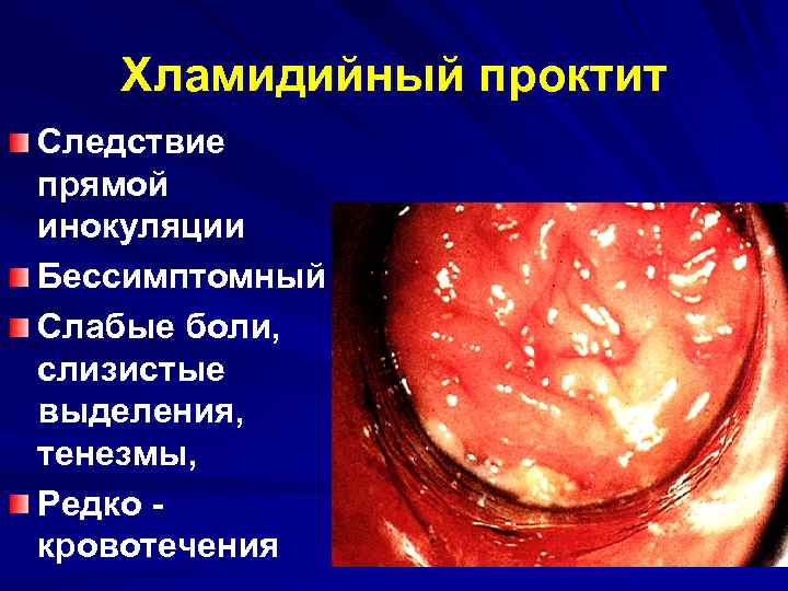 Хламидийный проктит Следствие прямой инокуляции Бессимптомный Слабые боли, слизистые выделения, тенезмы, Редко - кровотечения