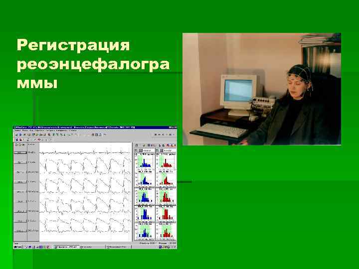 Регистрация реоэнцефалогра ммы 