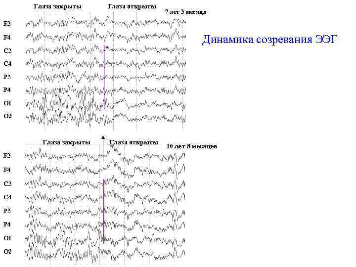 Глаза закрыты Глаза открыты 7 лет 3 месяца F 3 Динамика созревания ЭЭГ F