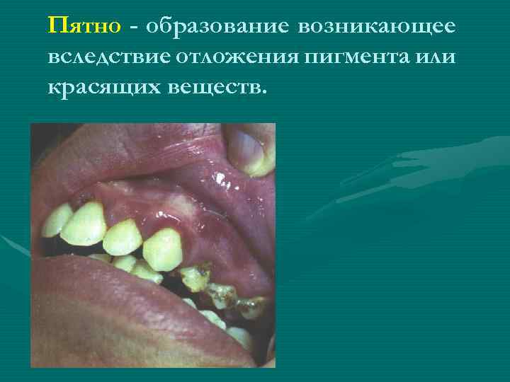 Пятно - образование возникающее вследствие отложения пигмента или красящих веществ. 
