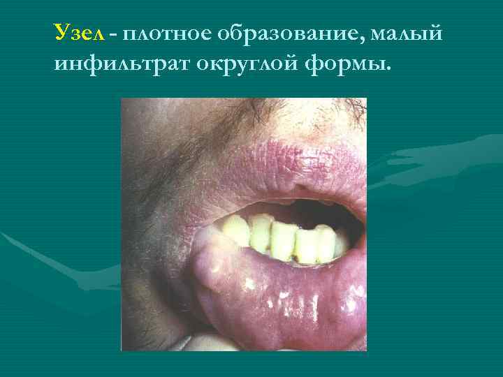 Узел - плотное образование, малый инфильтрат округлой формы. 