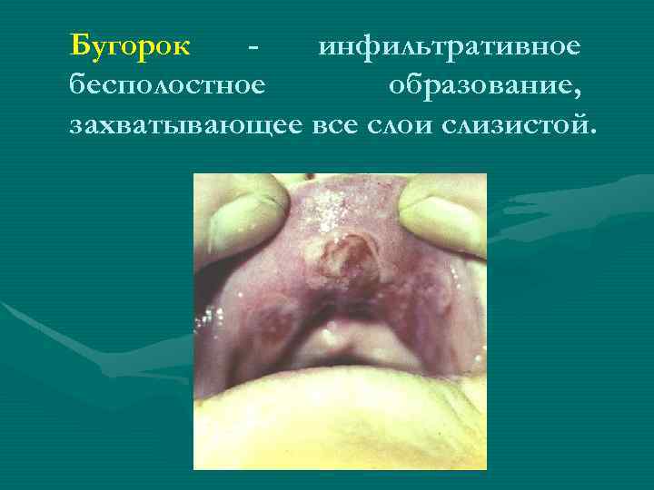 Бугорок инфильтративное бесполостное образование, захватывающее все слои слизистой. 