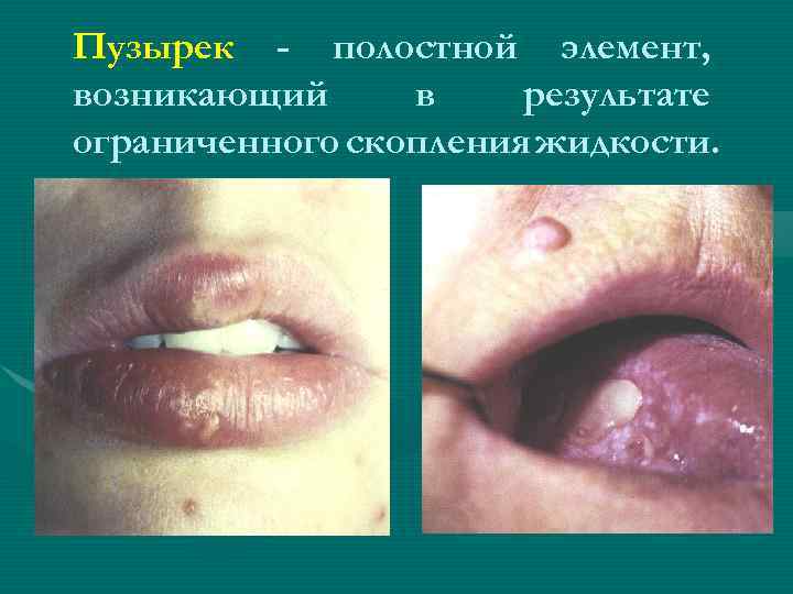 Пузырек - полостной элемент, возникающий в результате ограниченного скопления жидкости. 