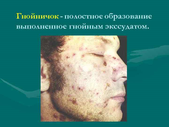 Гнойничок - полостное образование выполненное гнойным экссудатом. 