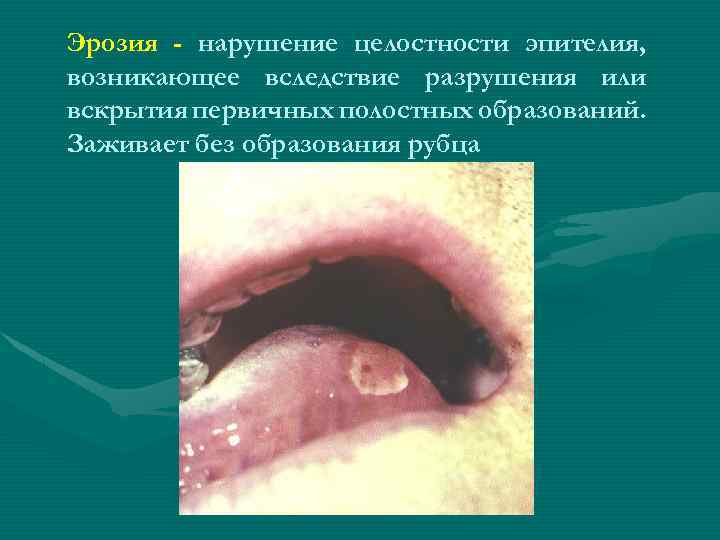 Эрозия - нарушение целостности эпителия, возникающее вследствие разрушения или вскрытия первичных полостных образований. Заживает