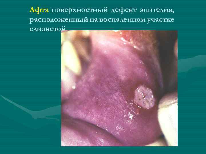Афта поверхностный дефект эпителия, расположенный на воспаленном участке слизистой. 