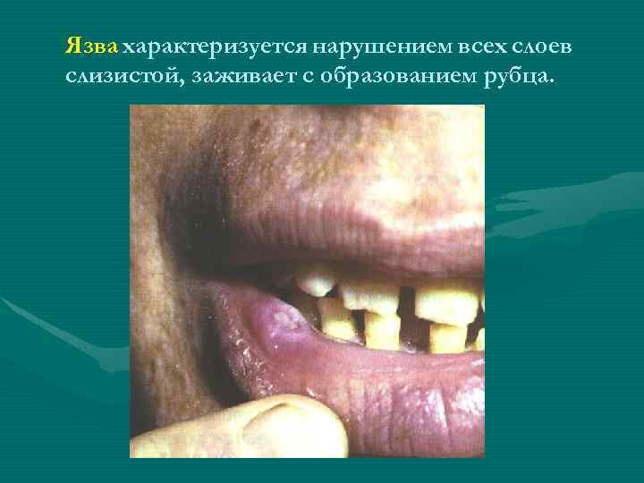 Язва характеризуется нарушением всех слоев слизистой, заживает с образованием рубца. 