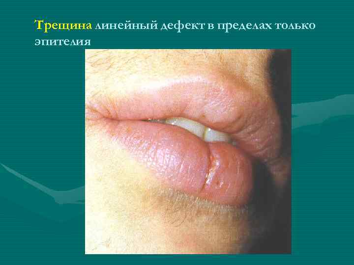 Трещина линейный дефект в пределах только эпителия 