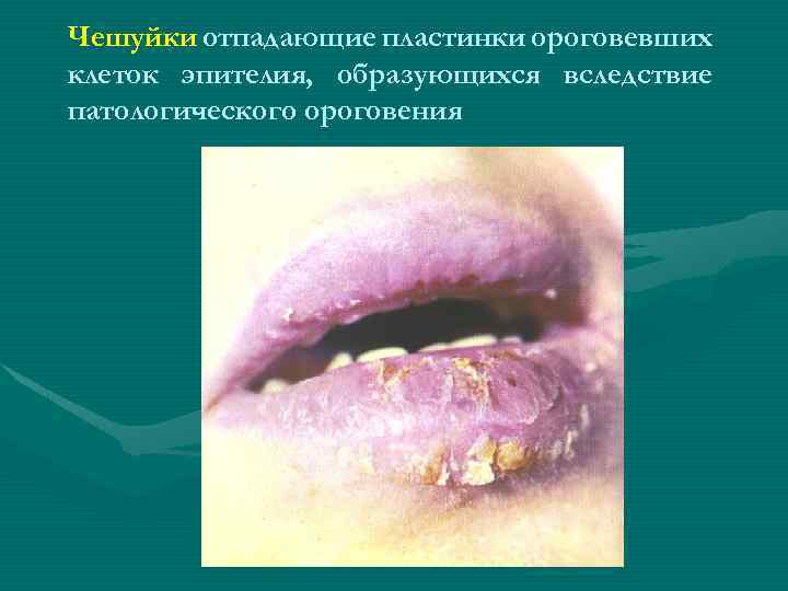 Чешуйки отпадающие пластинки ороговевших клеток эпителия, образующихся вследствие патологического ороговения 