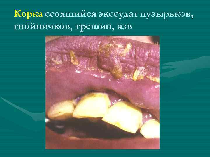 Корка ссохшийся экссудат пузырьков, гнойничков, трещин, язв 