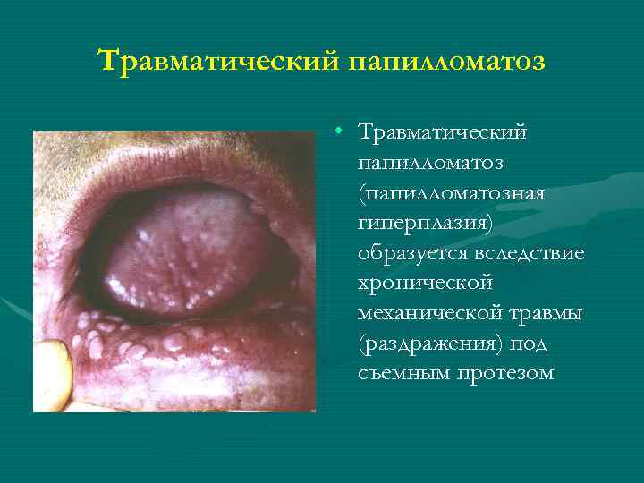Травматический папилломатоз • Травматический папилломатоз (папилломатозная гиперплазия) образуется вследствие хронической механической травмы (раздражения) под