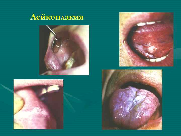 Лейкоплакия 