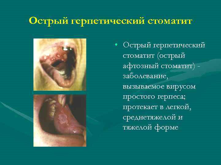 Острый герпетический стоматит • Острый герпетический стоматит (острый афтозный стоматит) заболевание, вызываемое вирусом простого