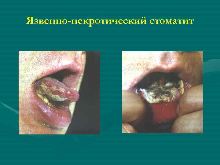 Язвенно-некротический стоматит 