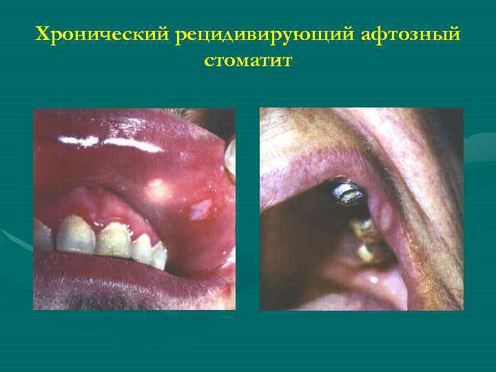 Хронический рецидивирующий афтозный стоматит 
