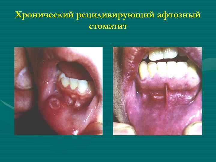 Хронический рецидивирующий афтозный стоматит 