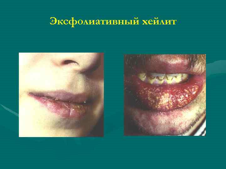 Эксфолиативный хейлит 