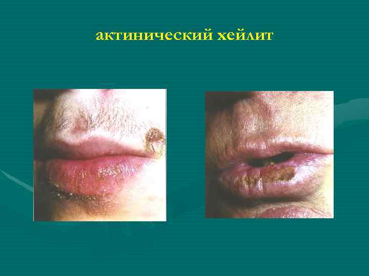 актинический хейлит 