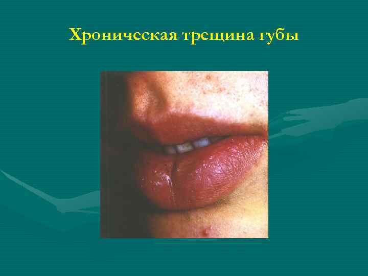 Хроническая трещина губы 