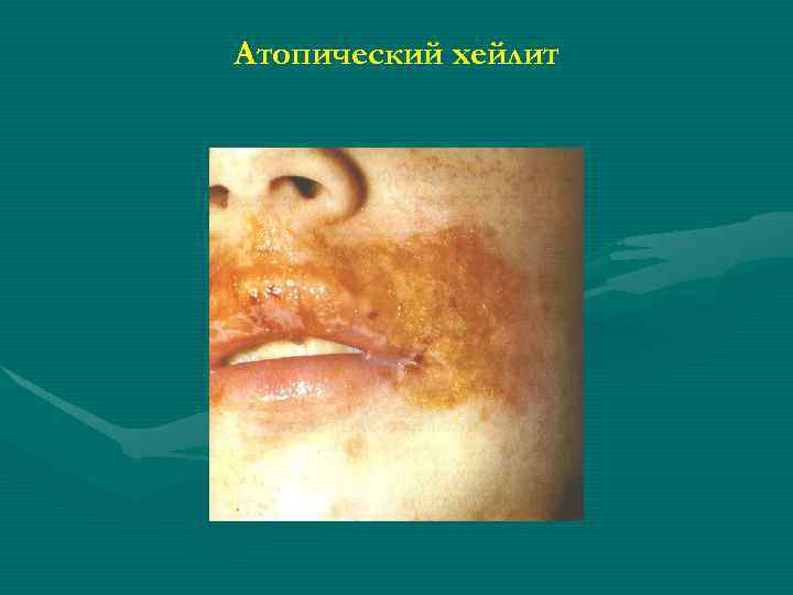 Атопический хейлит 