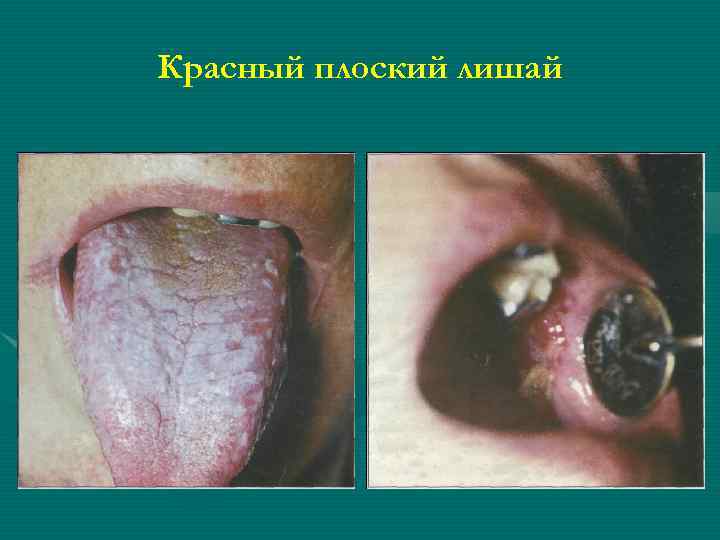 Красный плоский лишай 