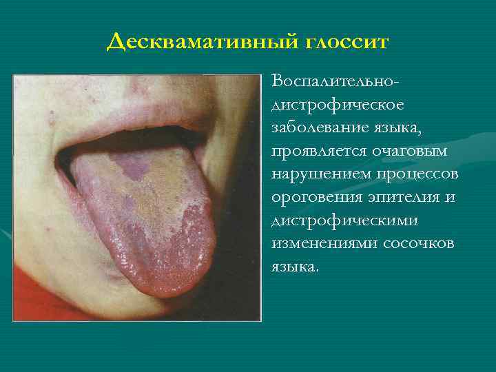 Десквамативный глоссит • Воспалительнодистрофическое заболевание языка, проявляется очаговым нарушением процессов ороговения эпителия и дистрофическими