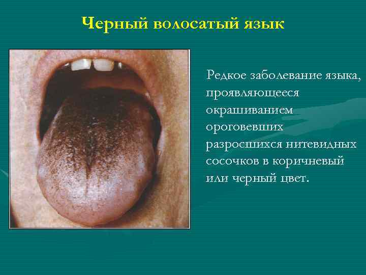 Черный волосатый язык Редкое заболевание языка, проявляющееся окрашиванием ороговевших разросшихся нитевидных сосочков в коричневый