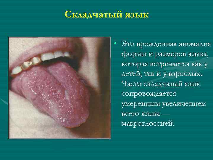 Складчатый язык • Это врожденная аномалия формы и размеров языка, которая встречается как у