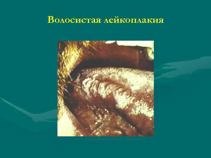 Волосистая лейкоплакия 
