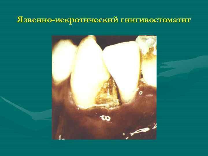 Язвенно-некротический гингивостоматит 