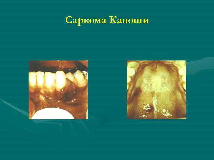 Саркома Капоши 