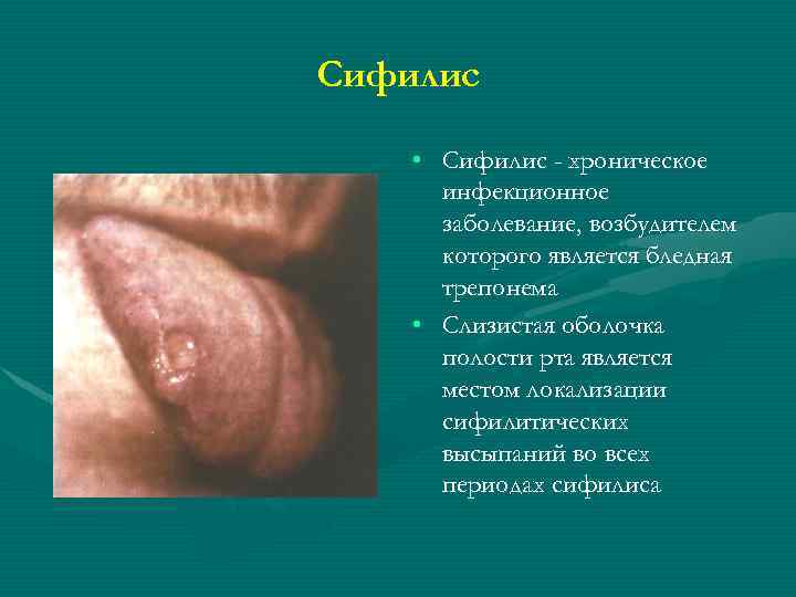 Сифилис • Сифилис - хроническое инфекционное заболевание, возбудителем которого является бледная трепонема • Слизистая