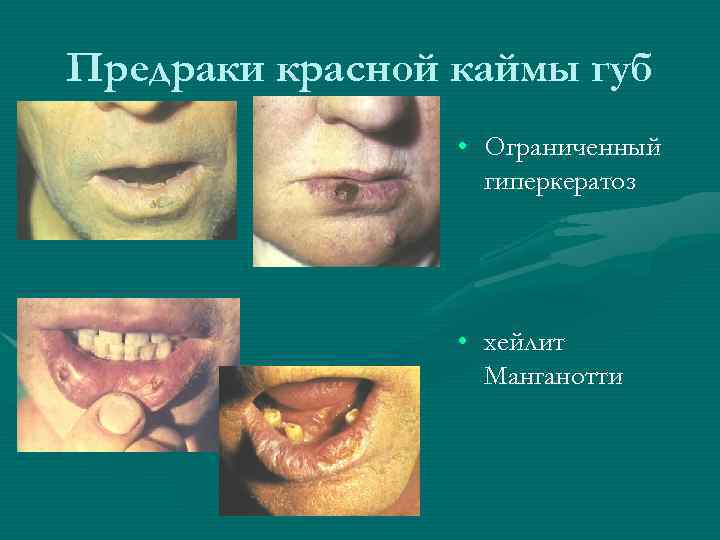 Предраки красной каймы губ • Ограниченный гиперкератоз • хейлит Манганотти 