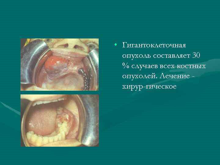  • Гигантоклеточная опухоль составляет 30 % случаев всех костных опухолей. Лечение хирур гическое