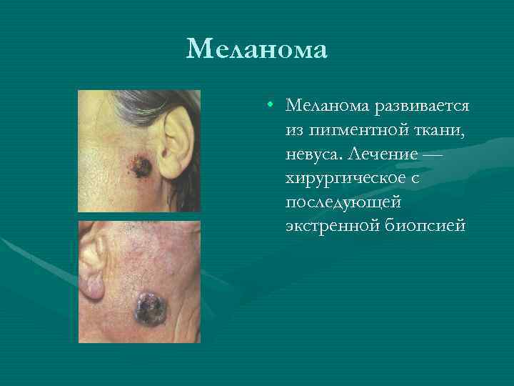 Меланома • Меланома развивается из пигментной ткани, невуса. Лечение — хирургическое с последующей экстренной