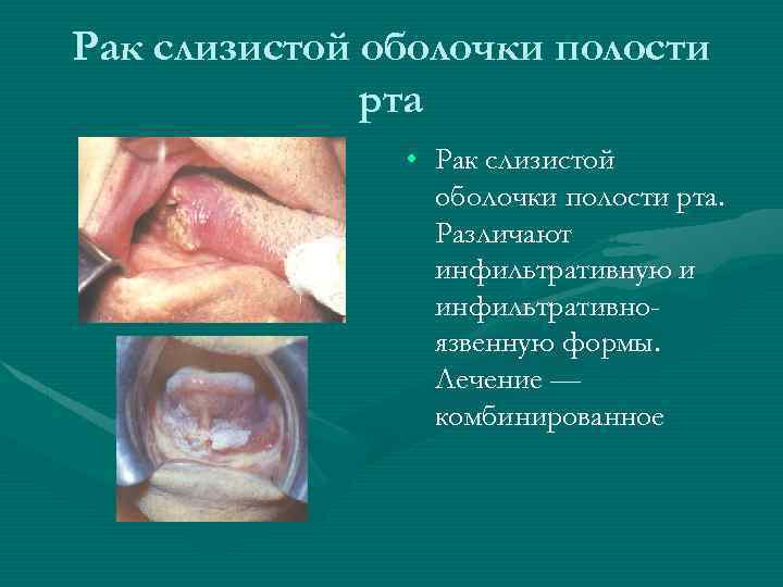 Рак слизистой оболочки полости рта • Рак слизистой оболочки полости рта. Различают инфильтративную и