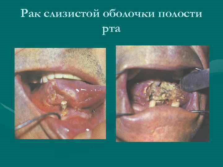 Рак слизистой оболочки полости рта 