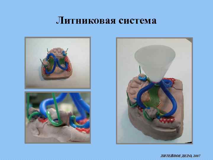 Литниковая система. Крыльчатка в литниковой системе. Литниковая система в стоматологии муфта. Литниковая система в стоматологии воронка. Литниковая система на бугеле моделирование.