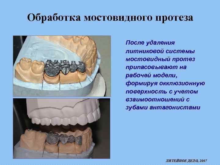 Обработка мостовидного протеза После удаления литниковой системы мостовидный протез припасовывают на рабочей модели, формируя