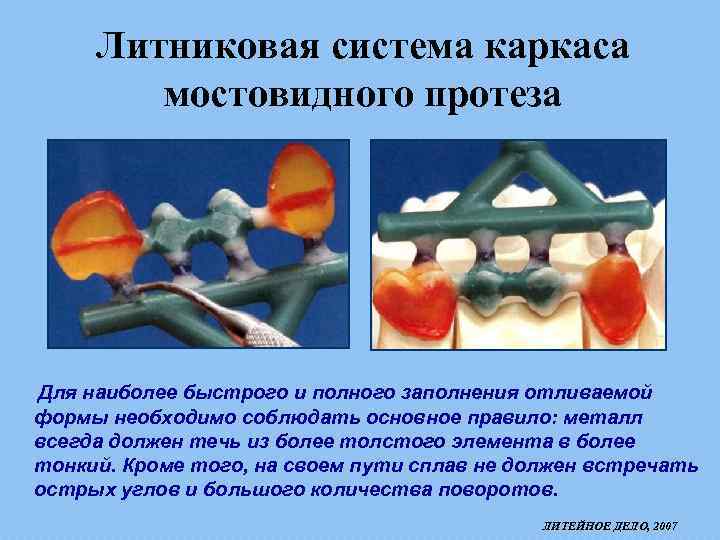 Литниковая система каркаса мостовидного протеза Для наиболее быстрого и полного заполнения отливаемой формы необходимо