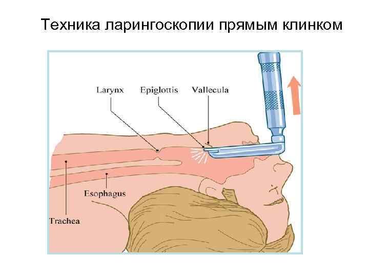 Техника ларингоскопии прямым клинком 