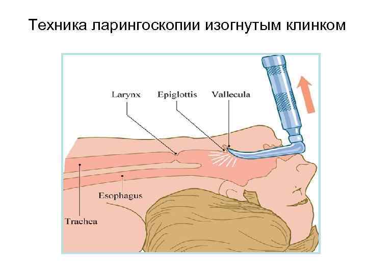 Ларингоскопия это