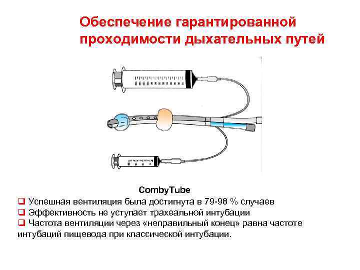 Обеспечение гарантированной проходимости дыхательных путей Comby. Tube q Успешная вентиляция была достигнута в 79