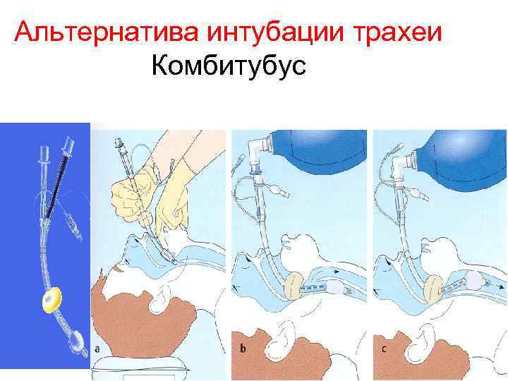 Альтернатива интубации трахеи Комбитубус 