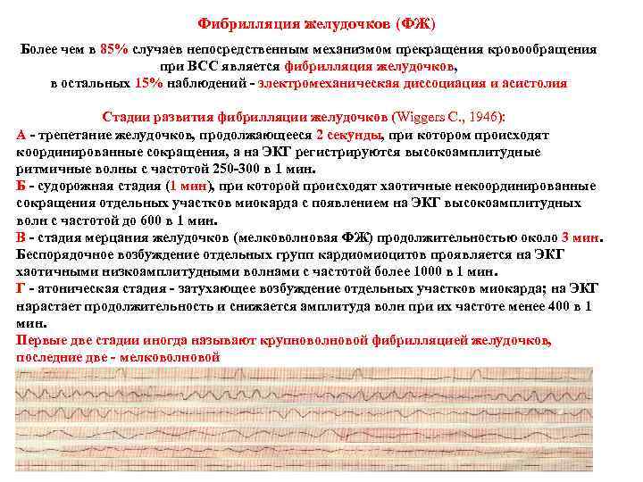Фибрилляция желудочков (ФЖ) Более чем в 85% случаев непосредственным механизмом прекращения кровообращения при ВСС