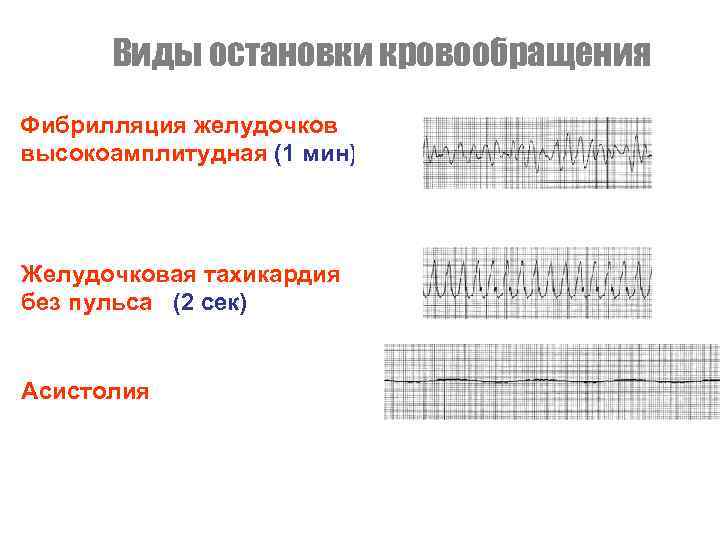 Виды остановки кровообращения Фибрилляция желудочков высокоамплитудная (1 мин) Желудочковая тахикардия без пульса (2 сек)