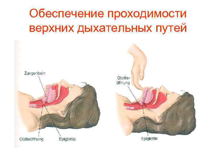 Обеспечение проходимости верхних дыхательных путей 